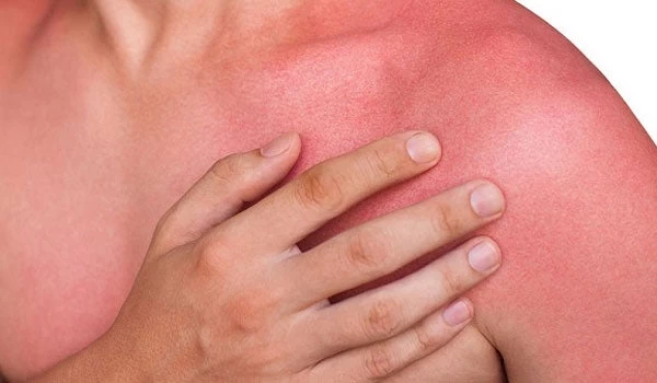 Σας έκαψε ο ήλιος; Με ποια αιθέρια έλαια μπορούμε να καταπραΰνουμε τον πόνο